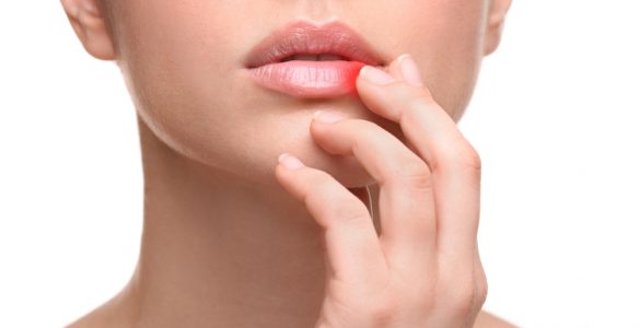 Woman with cold sore touching lips
