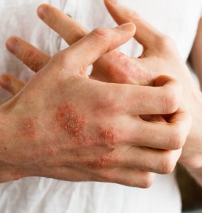 Close up of hands with eczema itching