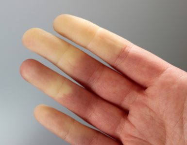 CLose up of hand showing someone suffering from Raynaud's disease