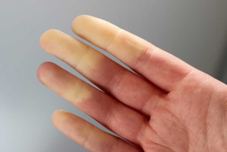 CLose up of hand showing someone suffering from Raynaud's disease
