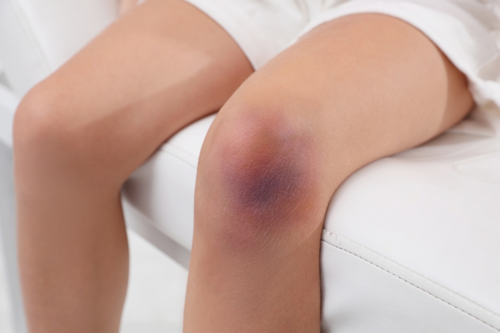 Close up of a bruised knee